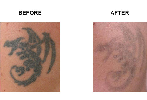 Tattoo removal - before and after