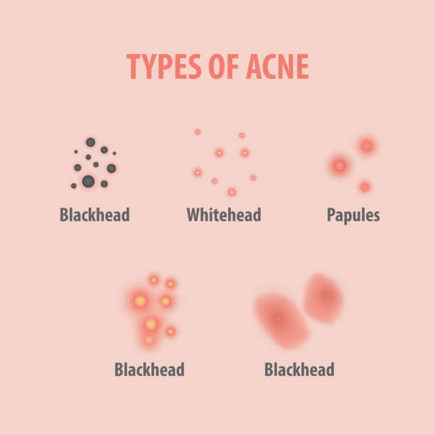 What's Acne And How It Happens